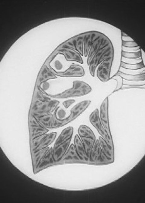 Preventing Tuberculosis